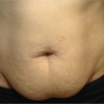 CoolSculpting Before & After Patient #868