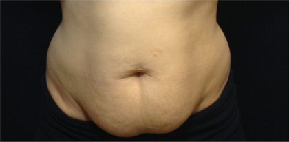 CoolSculpting Before & After Patient #868