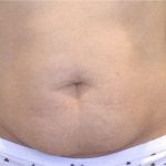 CoolSculpting Before & After Patient #868