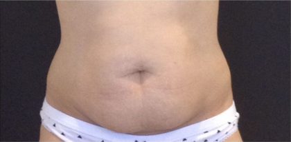 CoolSculpting Before & After Patient #868