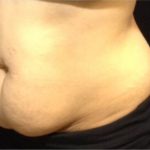CoolSculpting Before & After Patient #868