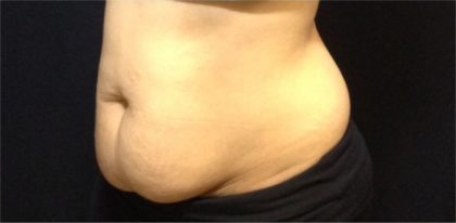 CoolSculpting Before & After Patient #868
