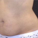 CoolSculpting Before & After Patient #868