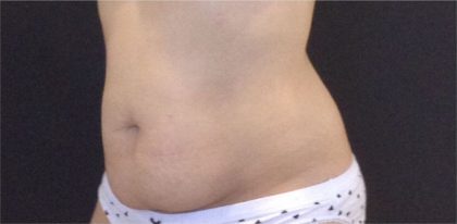 CoolSculpting Before & After Patient #868