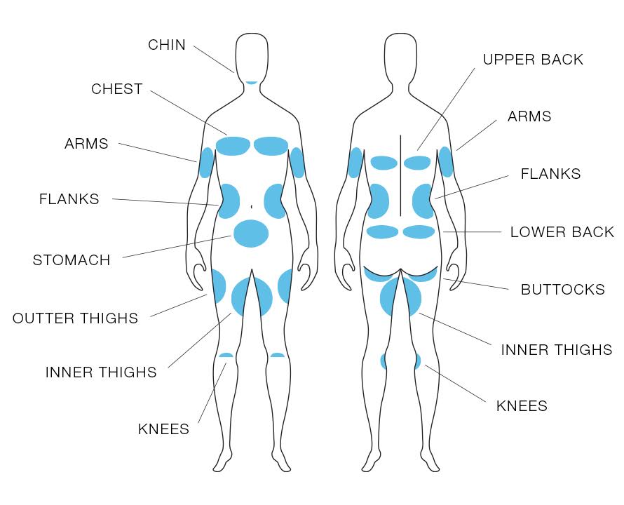 coolsculpting areas