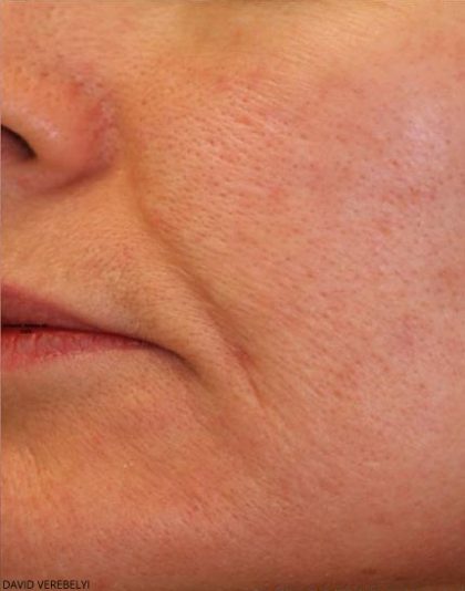 Laser Genesis Before & After Patient #725