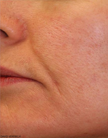 Laser Genesis Before & After Patient #725