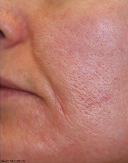 Laser Genesis Before & After Patient #725