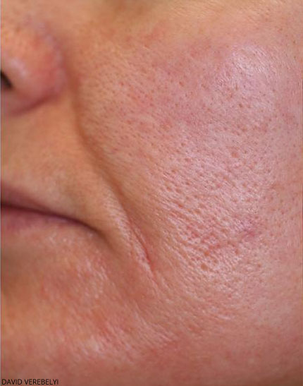 Laser Genesis Before & After Patient #725