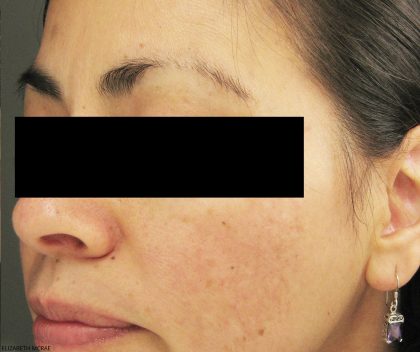 Laser Genesis Before & After Patient #731