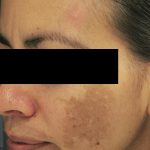 Laser Genesis Before & After Patient #731