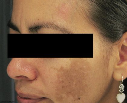 Laser Genesis Before & After Patient #731