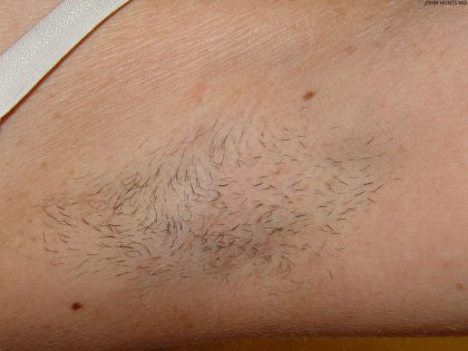 Laser Hair Removal Before & After Patient #734