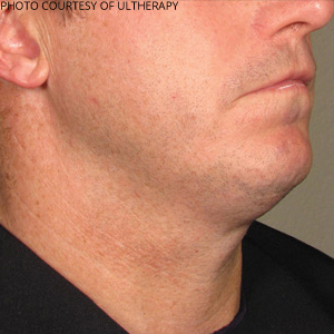 Ultherapy Before & After Patient #684
