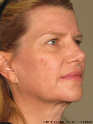 Ultherapy Before & After Patient #680