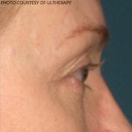 Ultherapy Before & After Patient #687