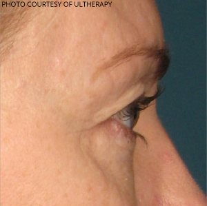 Ultherapy Before & After Patient #687