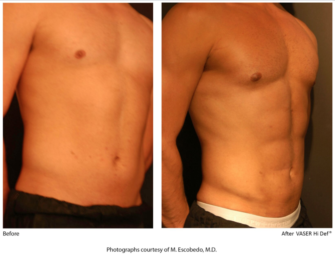 vaser liposuction results