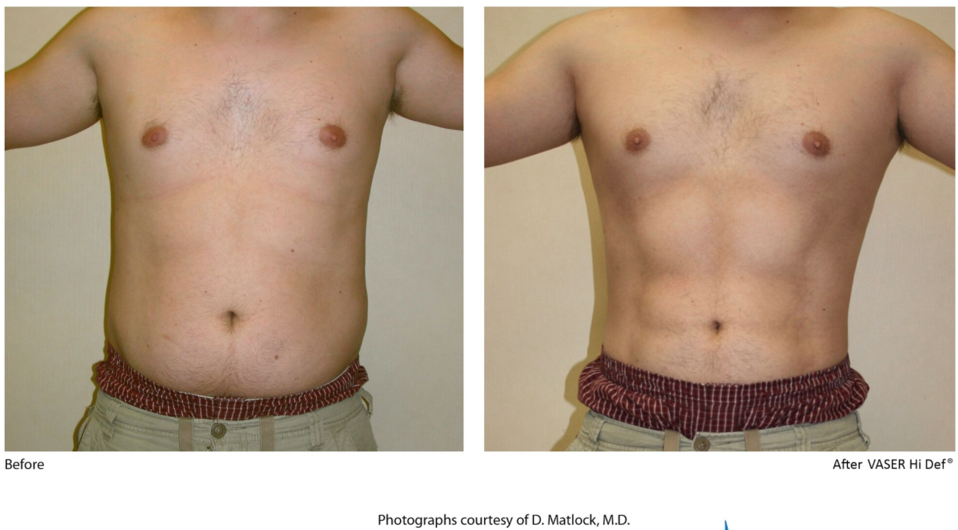 vaser liposuction results