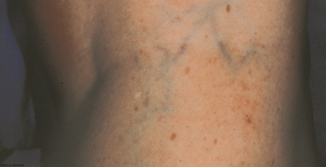 Vein Therapy Before & After Patient #666