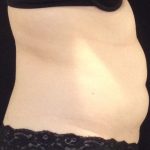 CoolSculpting Before & After Patient #1248