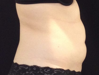 CoolSculpting Before & After Patient #1248