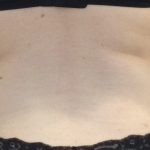 CoolSculpting Before & After Patient #1248