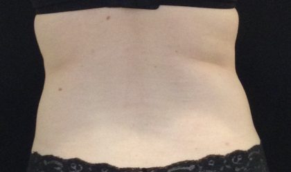 CoolSculpting Before & After Patient #1248