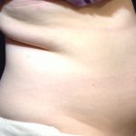 CoolSculpting Before & After Patient #1248