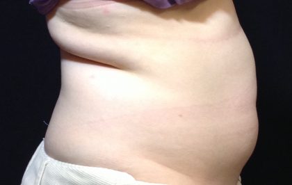 CoolSculpting Before & After Patient #1248