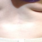 CoolSculpting Before & After Patient #1248