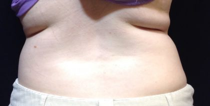 CoolSculpting Before & After Patient #1248