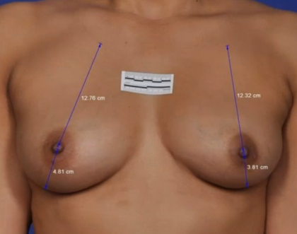 ThermiBreast Before & After Patient #1415
