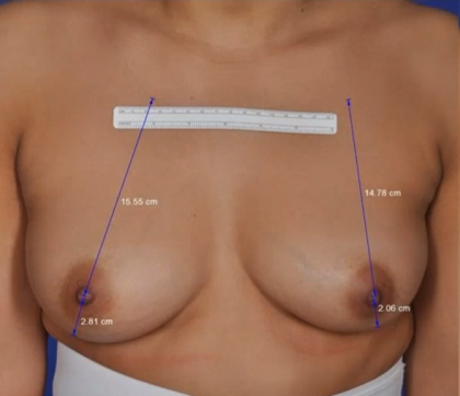 ThermiBreast Before & After Patient #1415