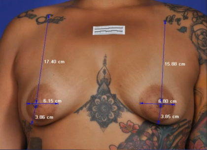 ThermiBreast Before & After Patient #1420