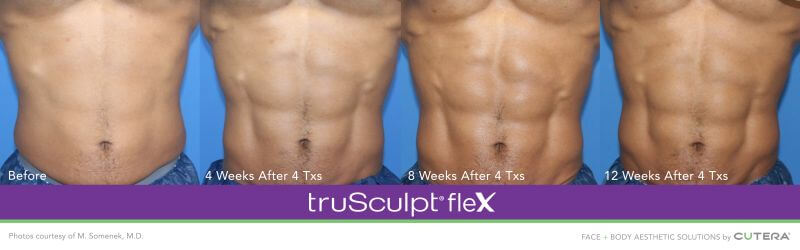 trusculpt flex progress photos