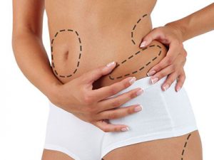 Vaser Liposuction in Portland, Oregon